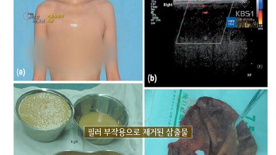 가슴성형의 그늘 | 인스티즈