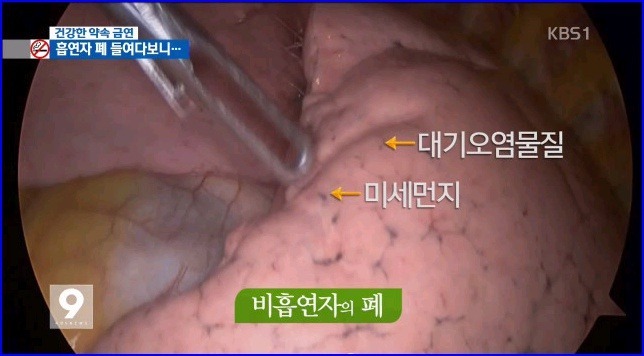 흡연자의 폐 | 인스티즈