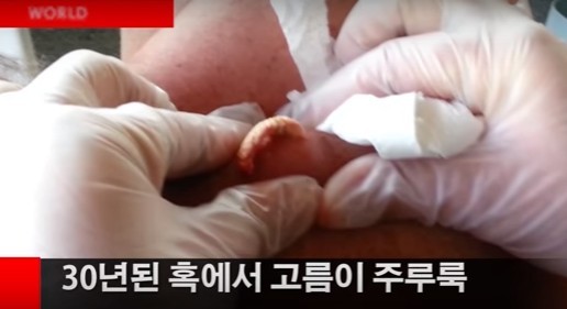 등 30년된 고름 짜기.gif (혐오주의) | 인스티즈