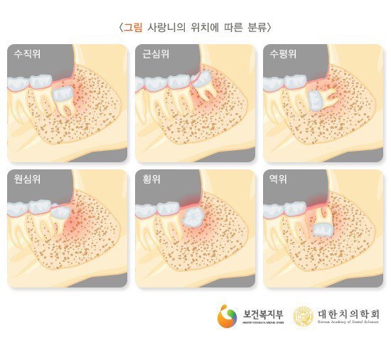 전생에 쌓은 업이 얼마나 큰지 알아보자(feat. 사랑니) | 인스티즈