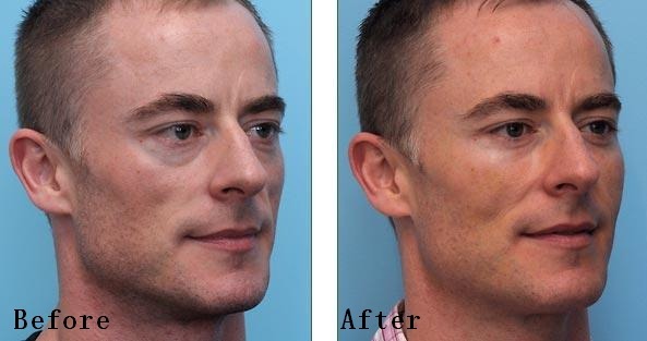 미국에서 많이하는 성형수술 세가지 | 인스티즈