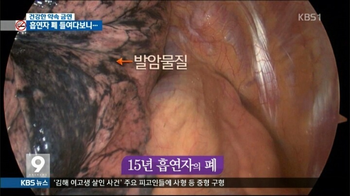 흡연자의 폐 | 인스티즈